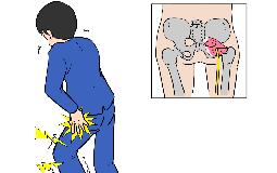 坐骨神経痛の辛さ